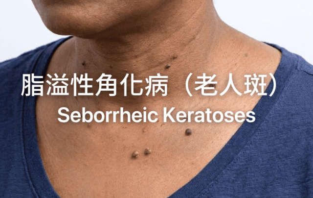 Seborrheic Keratoses